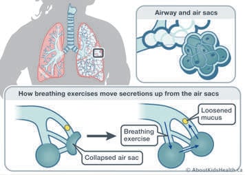 Close up of the air sacs in the lungs showing how breathing exercises can help to move secretions from the air sacs up into the larger airways