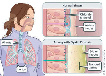 Comparison of a normal airway with watery mucus to cystic fibrosis airway with sticky mucus