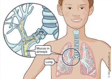 Enlarged illustration showing thick, sticky mucus in the bronchioles