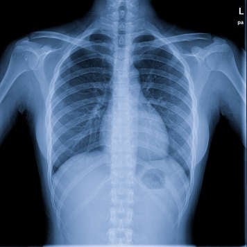 Normal chest X-ray